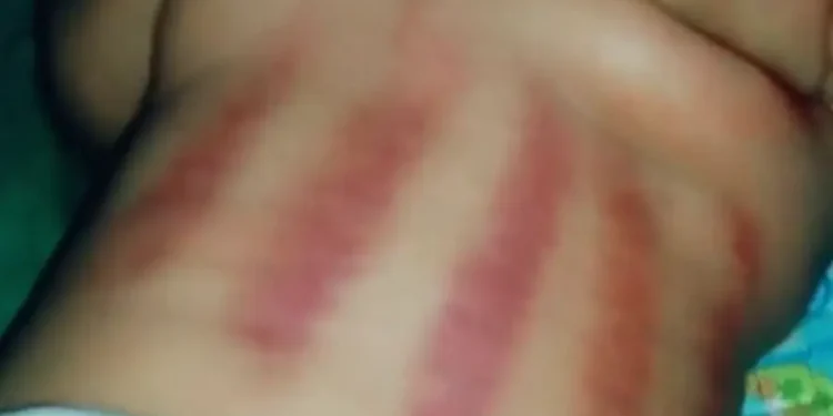 Viral Bayi di TikTok Dikerok Sampai Gosong, Ini Kata Dokter Anak UM Surabaya